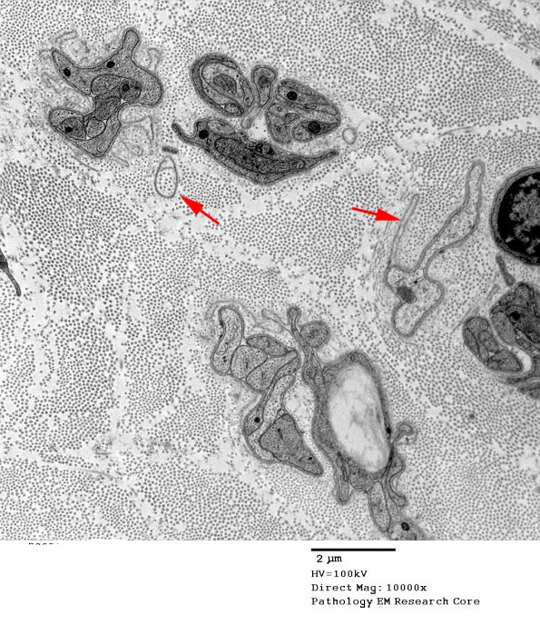 4I Axonal Degeneration (Case 21) EM 003 - Copy copy