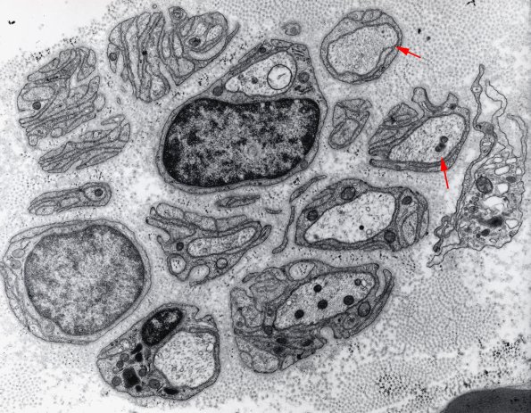 5A1 Axon loss (Case 22) EM - Copy copy