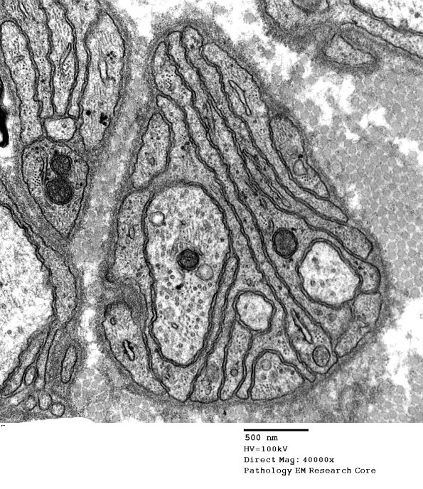 5B Axonal degeneration (Case 23) EM 054 - Copy