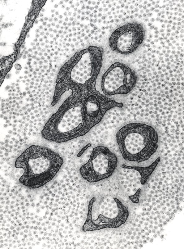5C1 Axon loss, Unmyelinated, collagen pockets EM 2 - Copy