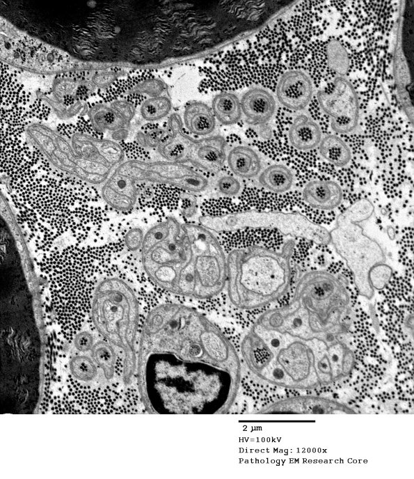 5D1 Collagen Pockets, unmyelinated (Case 25) EM 077 - Copy