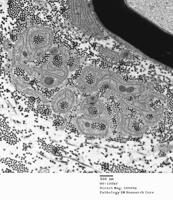 5D2 Bands Bungner, collagen pockets (Case 26) EM 3 - Copy