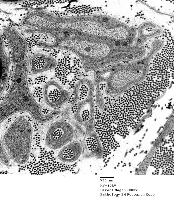 5D3 Collagen pockets, sural nerve (Case 27) EM 035 - Copy