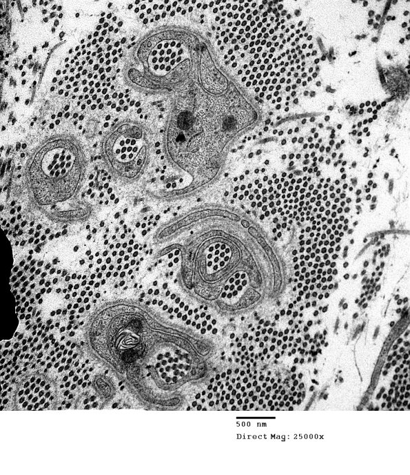 5D4 Collagen Pockets (Case 28) EM 014 - Copy