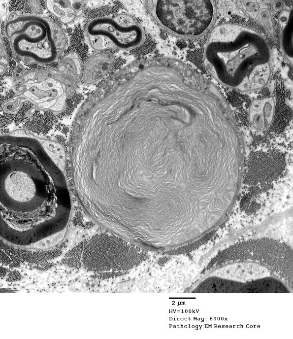 6A Axonal Degeneration (Case 29) EM 006 - Copy
