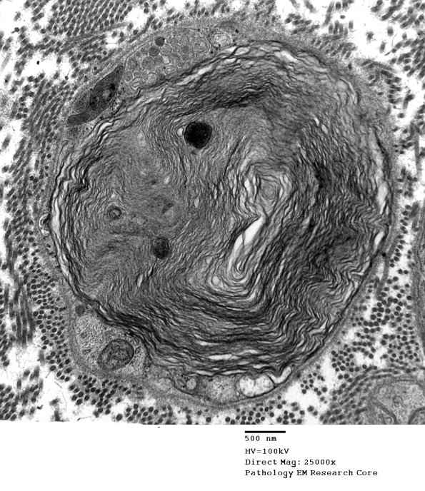 6D Axonal Degeneration (Case 7) EM 027 - Copy