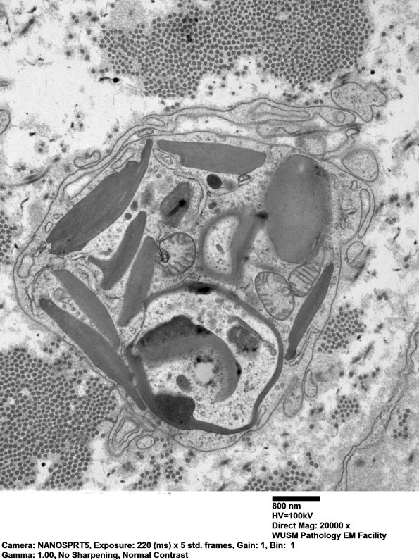 6E Axon loss (Case 32) EM 045 - Copy