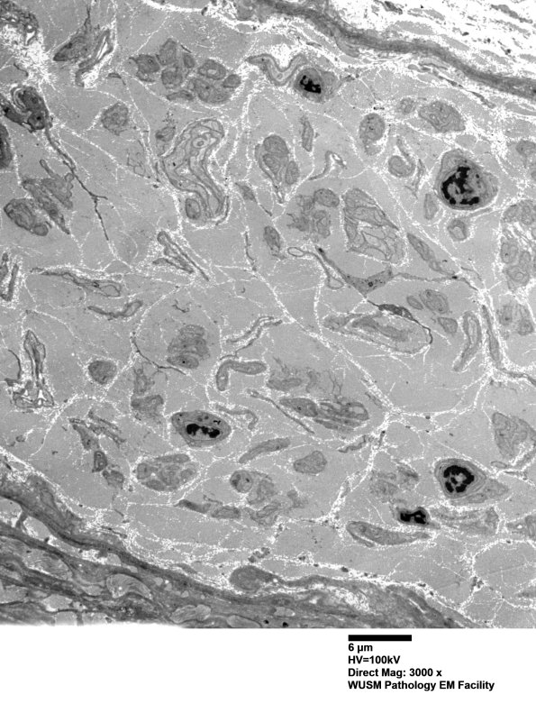 7A1 Chronic Degeneration (Case 33) Sural_058 - Copy