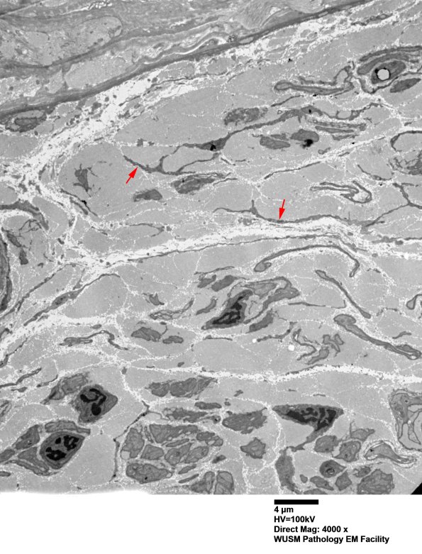 7A2 Chronic Degeneration (Case 33) Sural_036 copy - Copy