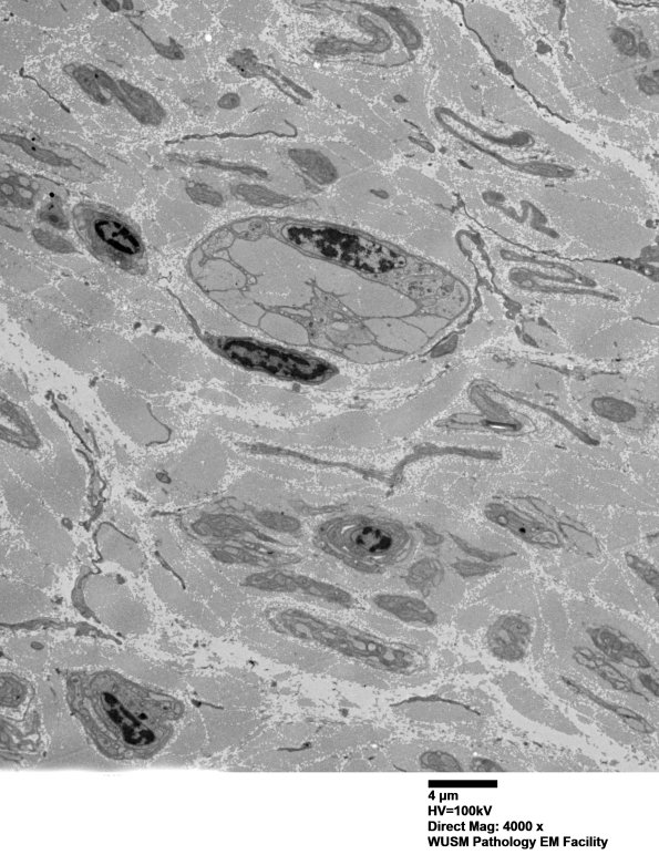 7A3A Chronic Degeneration (Case 33) Sural_040 - Copy