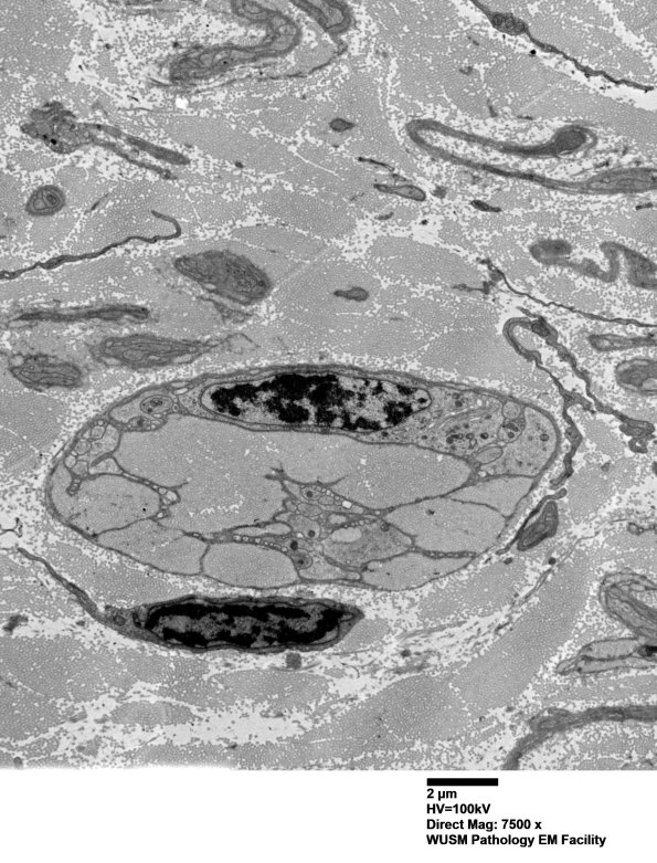7A3B Chronic Degeneration (Case 33) ural_041 - Copy