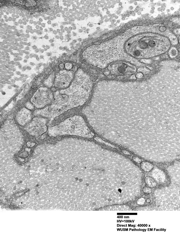 7A3D Chronic Degeneration (Case 33) Sural_046 - Copy