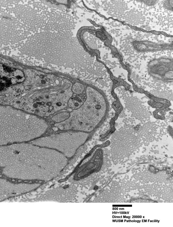 7A3E Chronic Degeneration (Case 33) Sural_042 - Copy