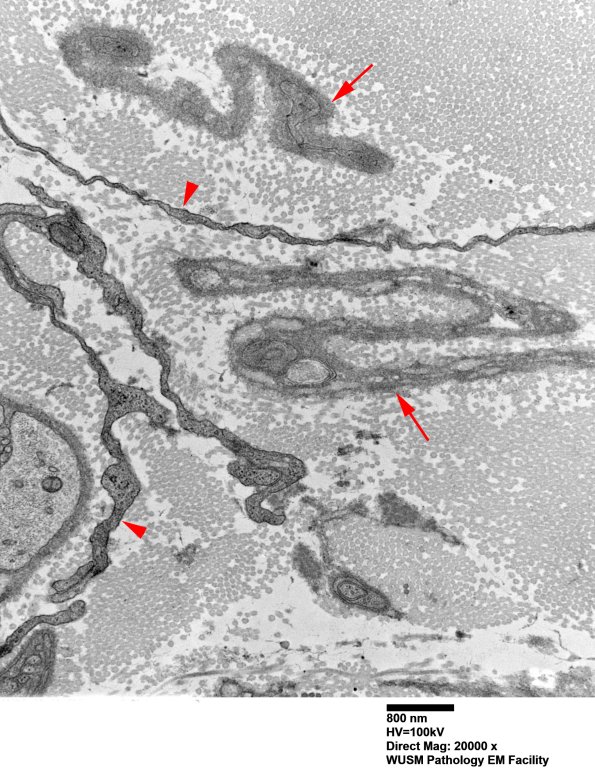 7A3F Chronic Degeneration (Case 33) Sural_043 copy - Copy