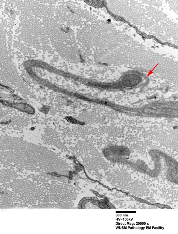 7A3G Chronic Degeneration (Case 33) Sural_044 copy - Copy