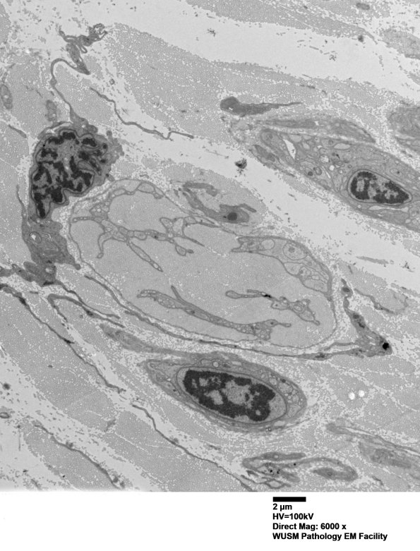 7A4A Chronic Degeneration (Case 33) Sural_048 - Copy