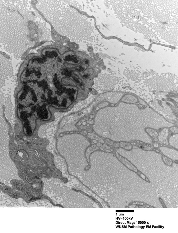 7A4B Chronic Degeneration (Case 33) Sural_049 - Copy