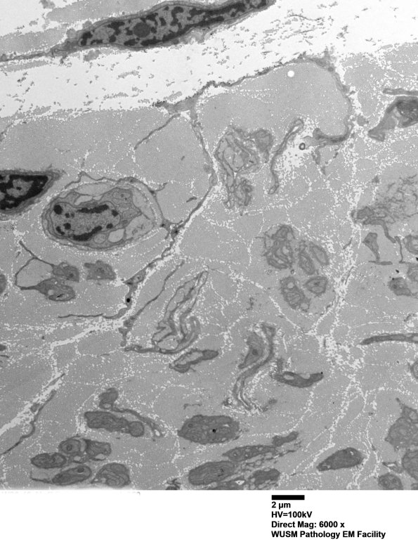 7A5A Chronic Degeneration (Case 33) Sural_050 - Copy