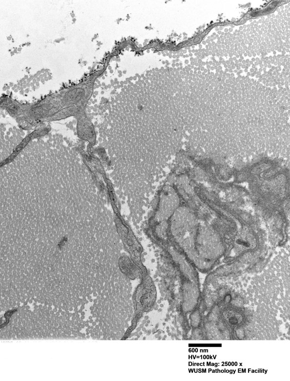 7A5B Chronic Degeneration (Case 33) Sural_052 - Copy