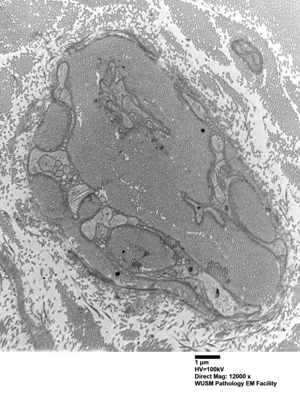 7A6A Chronic Degeneration (Case 33) Sural_054 - Copy