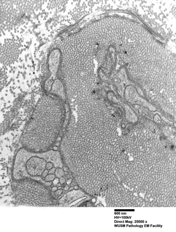 7A6B Chronic Degeneration (Case 33) Sural_055 - Copy