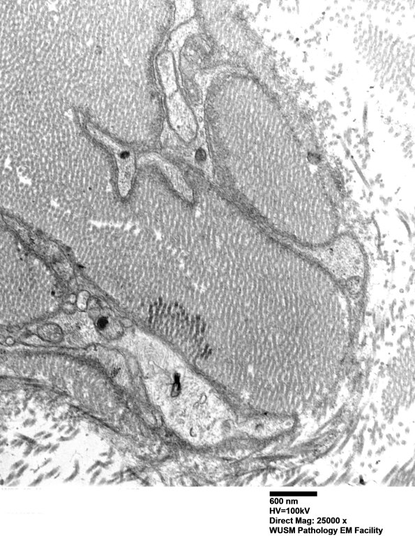 7A6C Chronic Degeneration (Case 33) Sural_056 - Copy