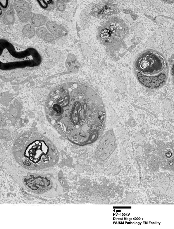 8C1 Axonal degeneration (Case 8) EM001 - Copy