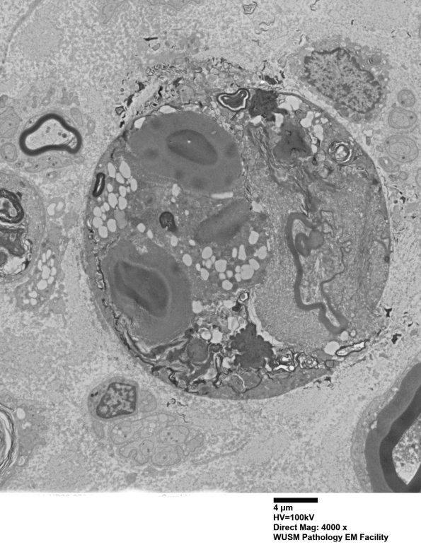 8C2 Axonal degeneration (Case 8) EM003 - Copy