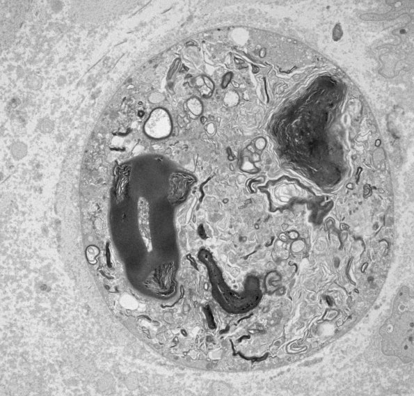 8C3 Axonal degeneration (Case 8) EM011 - Copy
