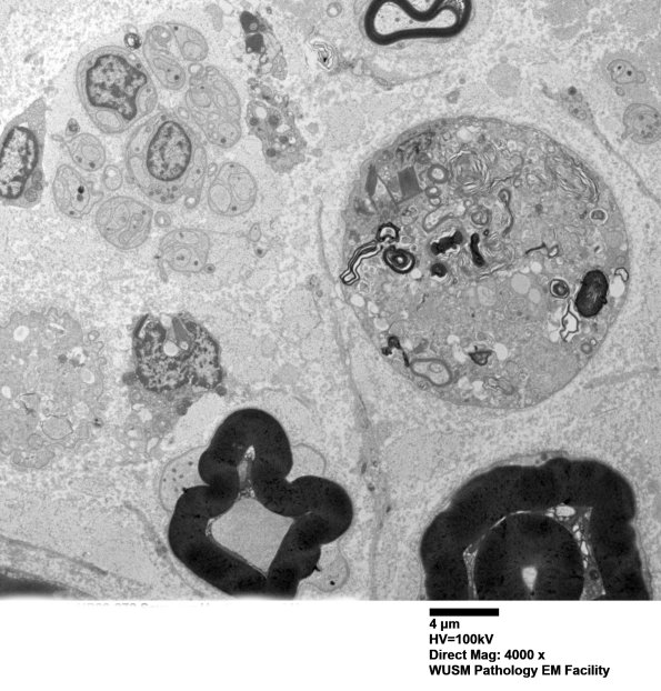 8C4 Axonal degeneration (Case 8) EM013 - Copy
