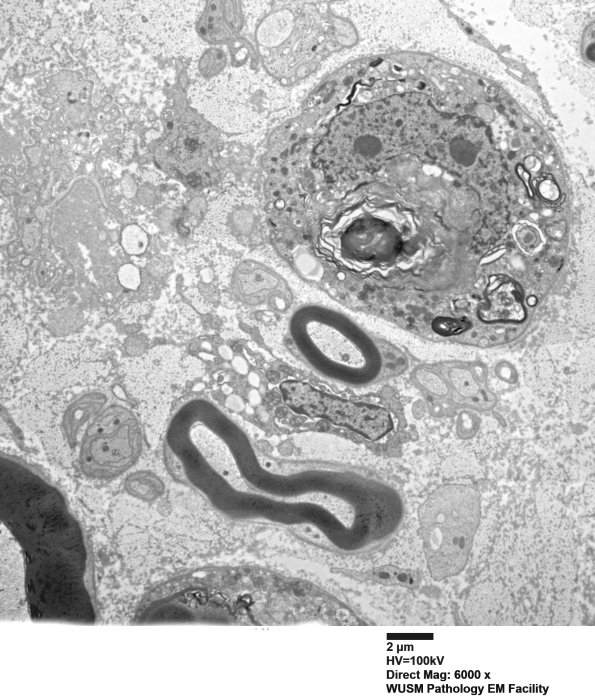 8C5 Axonal degeneration (Case 8) EM018 - Copy
