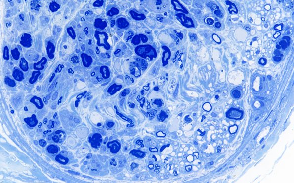 8D2 Axonal degeneration (Case 8) Plastic 60X 2