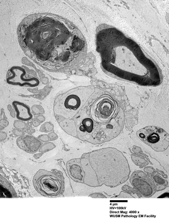 8E1A Axonal degeneration (Case 8) EM013 - Copy