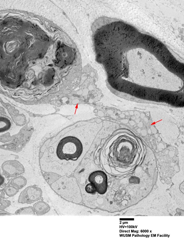 8E1B-Axonal-degeneration-Case-8-EM014-Copy-copy.jpg