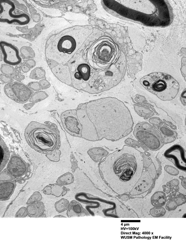 8E1C Axonal degeneration (Case 8) EM010 - Copy