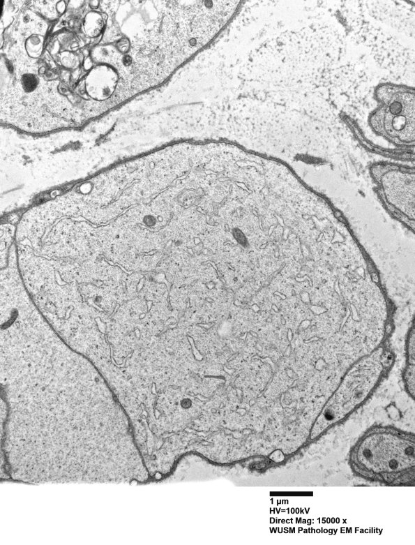 8E1D Axonal degeneration (Case 8) EM012 - Copy