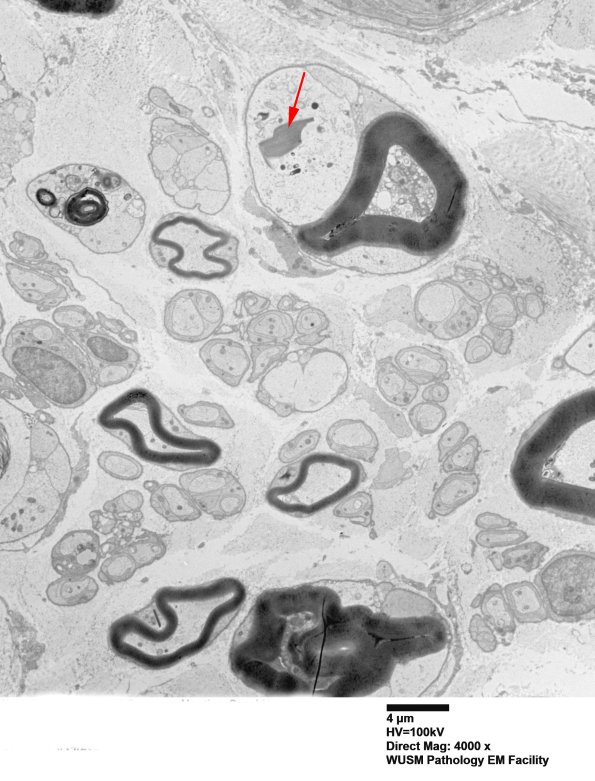 8E2A Axonal degeneration (Case 8) EM018 copy - Copy