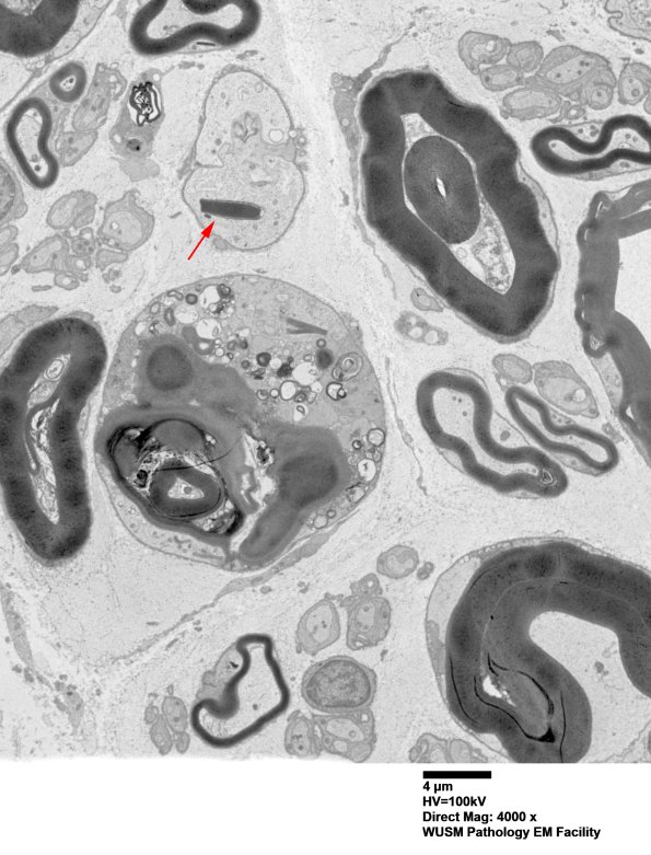8E2B Axonal degeneration (Case 8) EM001 - Copy copy