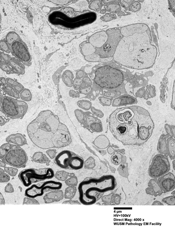 8E3 Axonal degeneration (Case 8) EM003 - Copy