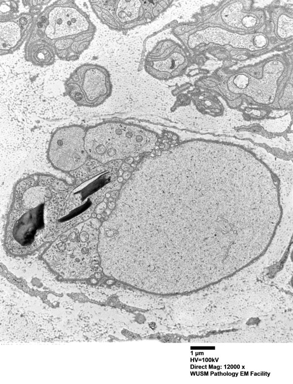 8E4 Axonal degeneration (Case 8) EM005 - Copy