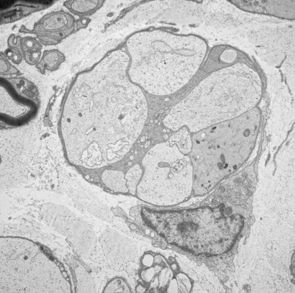 8E5 Axonal degeneration (Case 8) EM008 - Copy