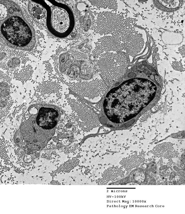 1A Axonal Degeneration (Case 1) EM 030 - Copy