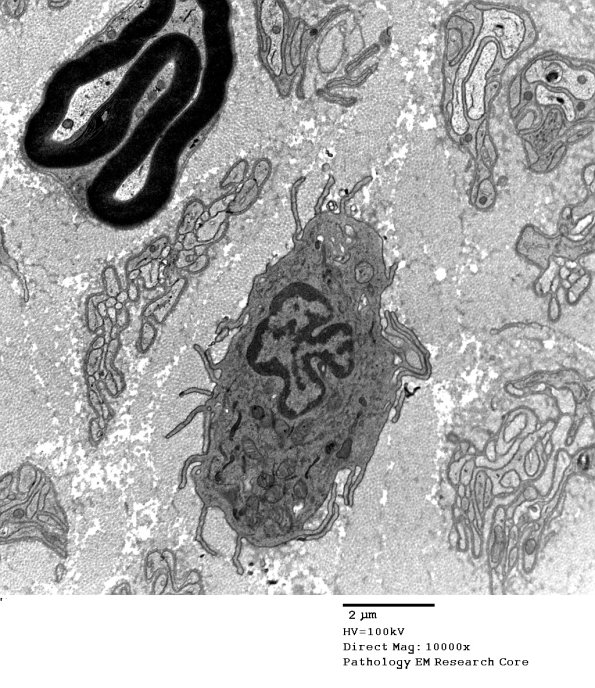 1B2 Axonal Degeneration Macrophage (Case 2) EM 101 - Copy