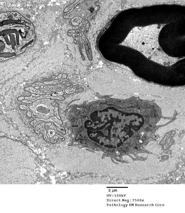 1B4 Axonal Degeneration Macrophage (Case 2) EM 061 - Copy
