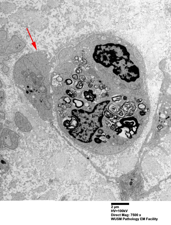 2A Axonal Degeneration & Regeneration (Case 3) EM 029A copy - Copy