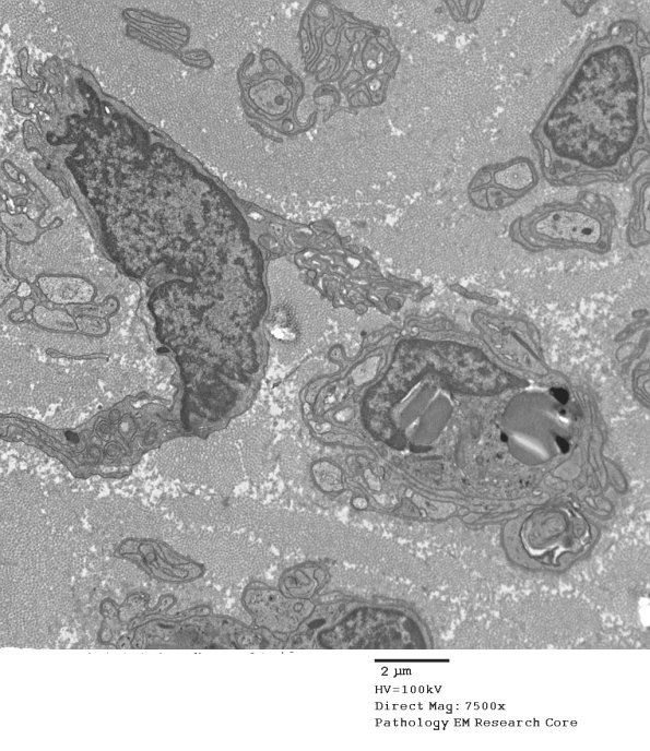 2B Axonal Degeneration (Case 2) EM 137 - Copy