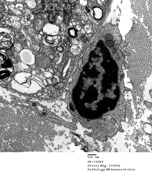 2C Axonal Degeneration (Case 4) 054 - Copy