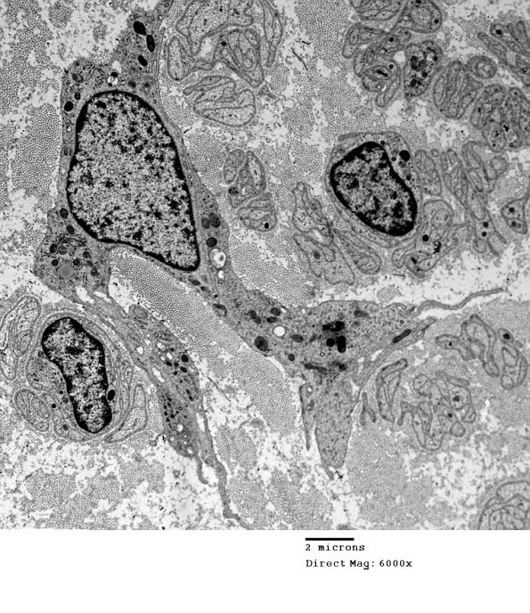 2D1 Axonal Degeneration, granular axoplasm, sarcoid (Case 5) EM 028 - Copy