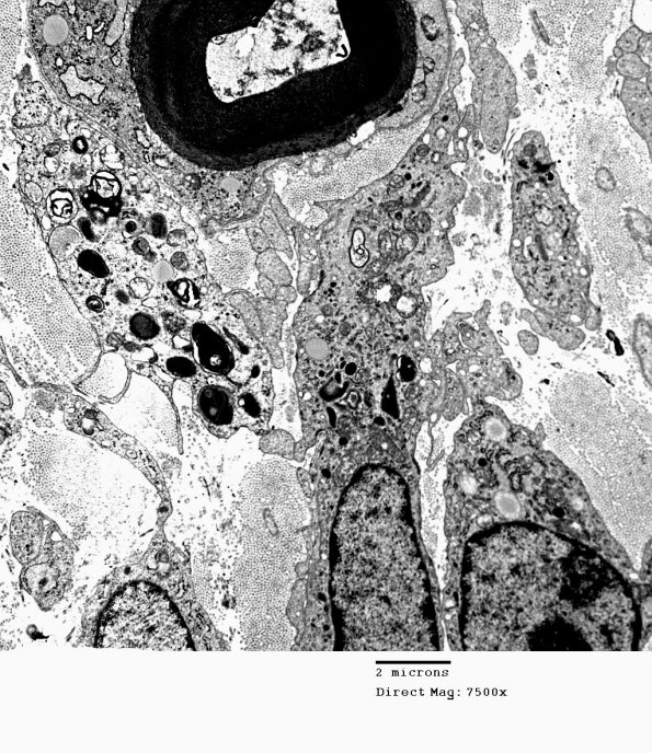 2D2 Axonal Degeneration, granular axoplasm, sarcoid (Case 5) EM 033 - Copy