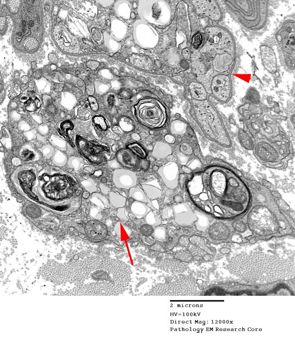 3A1 Axonal Degeneration (Case 7) EM 024 - Copy copy